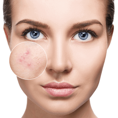 IPL Acne & Scar Treatment